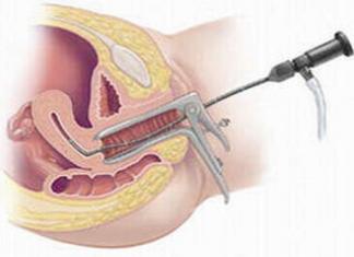 Histeroscopia con extirpación de un pólipo en el útero: indicaciones, características de implementación y recuperación.